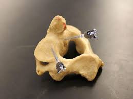 If the Vertebral Body is Fractured, Why not to Fix the Pedicle of the Injured Vertebra? A Technical Note