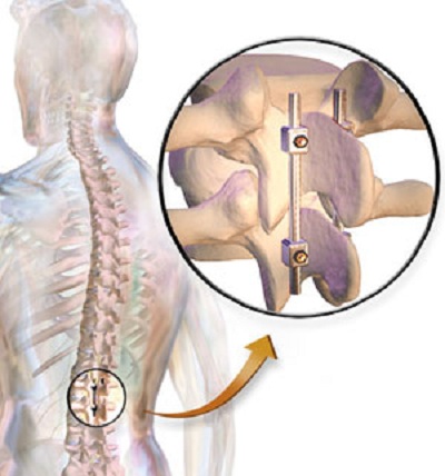 Clinical and Radiographic Outcome in Less Invasive Lumbar Fusion: XLIF at Two Year Follow-Up