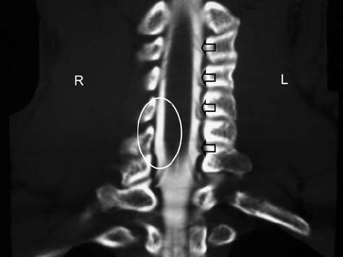 Multiple Nerve Root Injuries after Incidental Durotomy: Case Report with Anatomical Correlation and Review of Literature