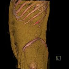 Upward Migration of Lumboperitoneal Shunt in Patient with Idiopathic Intracranial Hypertension: A Case Report