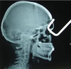 Orbitocranial Injury by a Ballpoint Pen in a Child: A Case Report