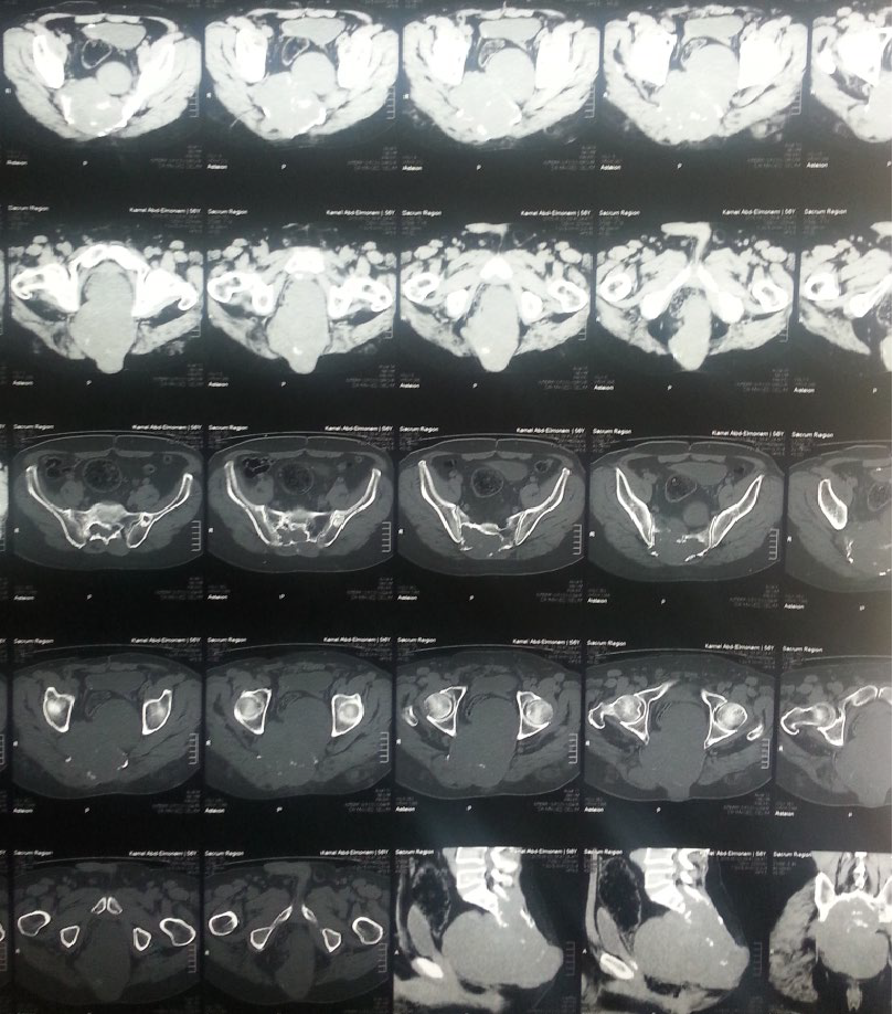 Surgical Excision of Large Sacral Chordoma with Lumbopelvic Fixation