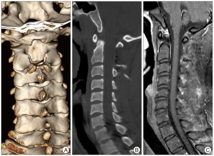 C1 Arch Reconstruction: A Novel Alternative to Fusion in Maintaining Mobility of the Atlanto-Axial Joint