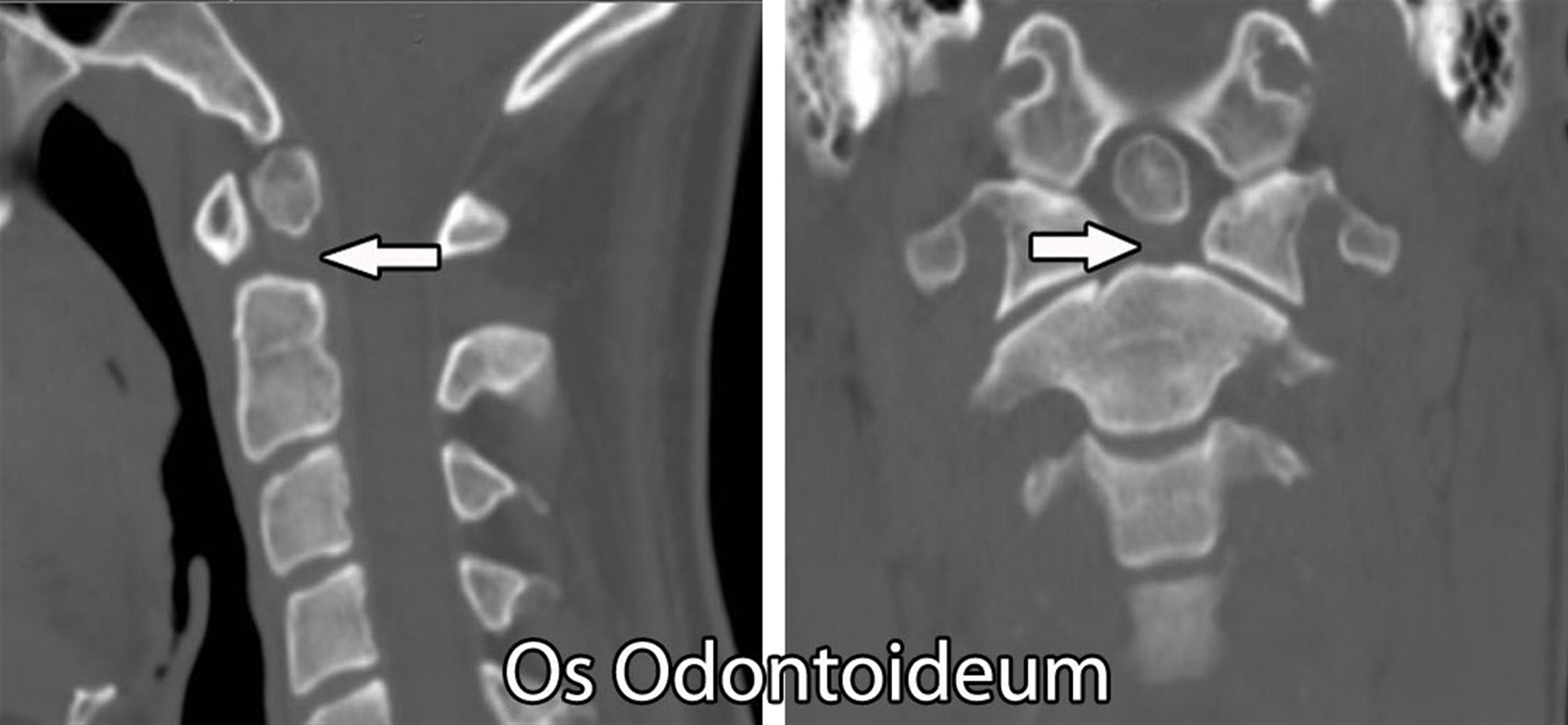 Surgical Management of an Elderly Patient with Free Floating Os Odontoideum