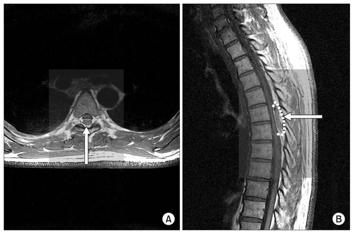 Spontaneous Spinal Epidural Haematomas in Adults: A Systematic Review