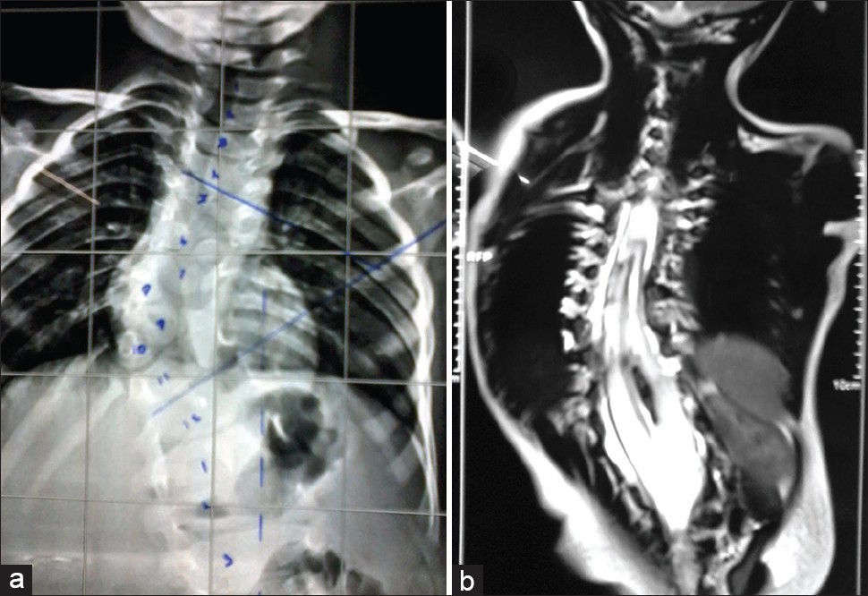 Split-Cord Malformation of the Cervical Spinal Cord Following Dorsal Root Entry Zone Lesioning Surgery