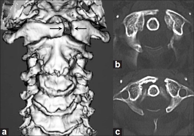Spontaneous C1 Anterior Arch Fracture Following C1 Laminectomy for Cervical Meningioma: A Case Report and Review of Literature