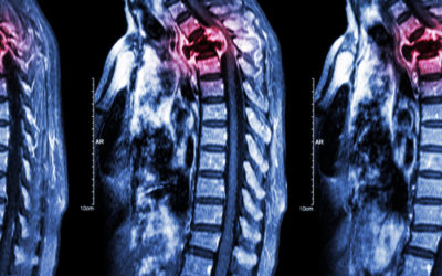 Spinal Epidermoid Tumor â€“ A Rare and Silent Occurrence
