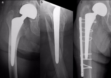 Loss of Anteversion in Left Sided Hemiarthroplasty with the Use of Modular Threaded Inserters
