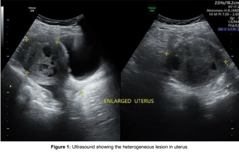 An Asymptomatic Case of Mullerian Adenosarcoma following Tamoxifen Use