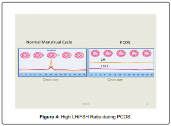 Polycystic Ovary Syndrome (PCOS) - Hormonal Change In Reproductive Women