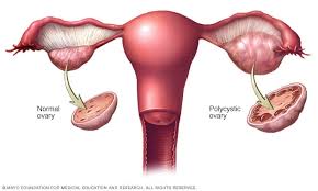 Awareness, Prevalence, Attitudes, and Practice of Polycystic Ovarian Syndrome among University Students