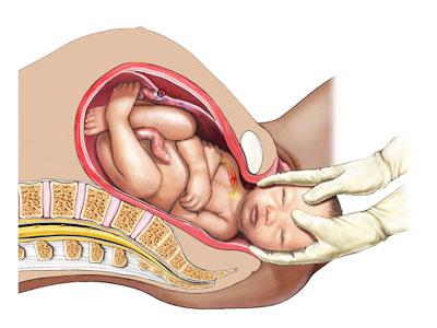 Nesfatin-1 Differences in Cesarean Section Compared to Natural Vaginal Delivery