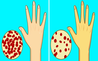 Hyperhomocysteinemia and Folate Deficiency in Preterm Premature Rupture of Membranes: A Hospital Based Case Control Study (India)