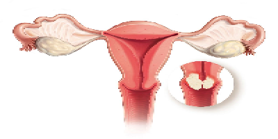 Knowledge, Attitude and Preventive Practices among the Female Students Regarding Cervical Cancer Screening and HPV Vaccination in Jazan University