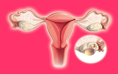 Polycystic Ovary Syndrome: A Review of Management Outcomes in a Low Resource Setting