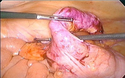 Adoption of Laparoscopy in a Rural Medical College Hospital: Minimal Access Surgery for Masses a Reality