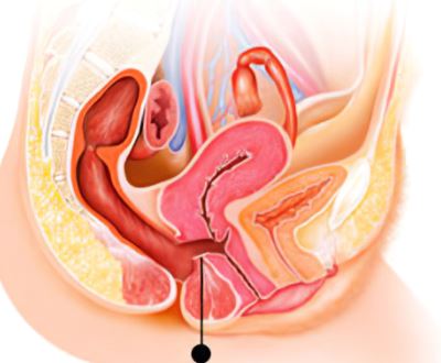 Physical, social and economic consequence of obstetric fistula among women who were managed in Jimma University Medical Center, Southwest Ethiopia.