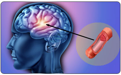 Stroke in Pregnancy