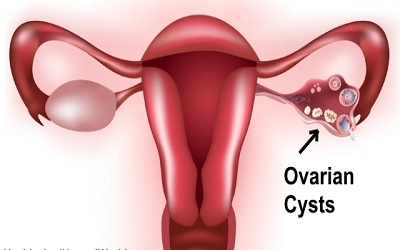 Ultrasound-guided Puncture of Complicated Ovarian Cysts: An Alternative to Surgery in Sub-Saharan Africa