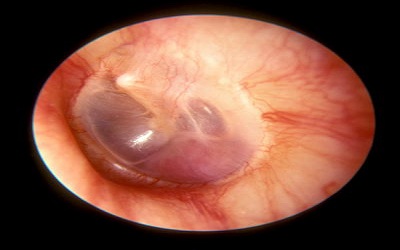 Glomus Tumor in Vulva with Uncertain Malignant Potential