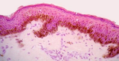 The Correlation of the Lifestyle and Medical Conditions with the Incidence of Micronuclei in the Vaginal Epithelial Cells