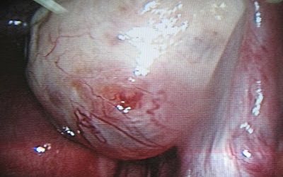 Post Caesarean Section Uterocutaneous Fistula: A Case Report