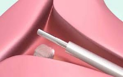Cervical Myomatous Polyp Leading to Third Degree Uterine Prolapse in Virgin Lady with Intact Hymen