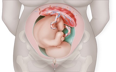 Maternal and Umbilical Cord Blood Level of Leptin and C-Reactive Protein in Preeclamptic Sudanese Women