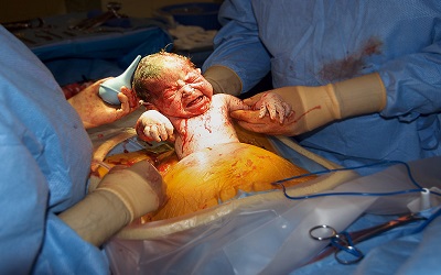 Caesarean Section Epidemic: A Cause for Concern