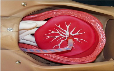 Interstitial Implantation of the Placenta presenting with Retained Placenta after Vaginal Delivery at Term