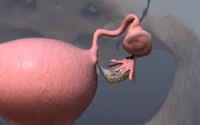 Diagnosis, Management and Outcomes of Heterotopic Pregnancies: About 28 Cases with Literature Review