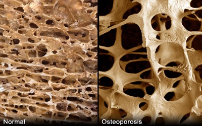 Ageing of Bone Structure and the Risk of Osteoporosis in the Menopausal Transition