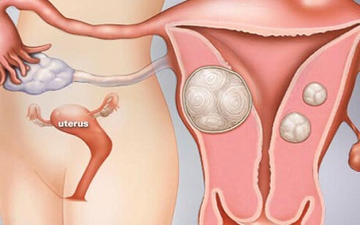 A Rare Case of Extra-Uterine Pelvic Leiomyoma