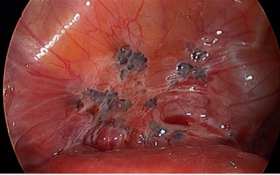 Long-Term Mental and Physical Quality of Life after Radical and Conservative Surgeries and in Relation to Childbirth in Patients with Severe Endometriosis