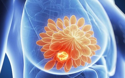 Women’s Knowledge of Breast Cancer: A Cross-Sectional Study