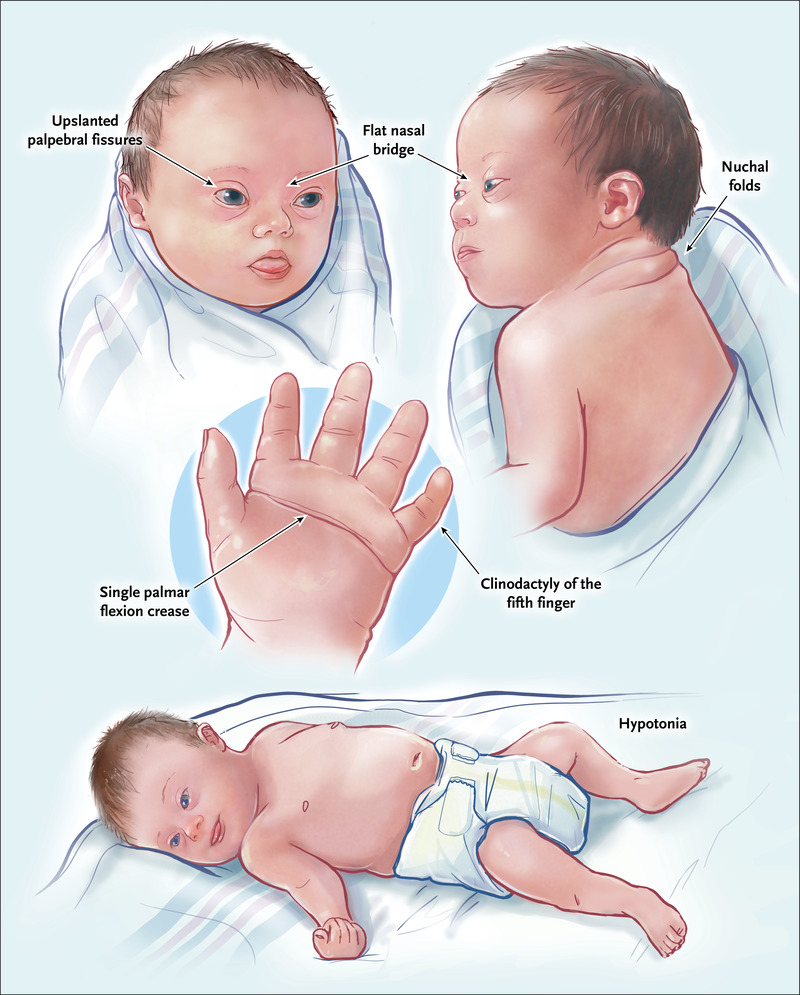 Impact on Physical Fitness, Functional Mobility, and Cognitive Functioning in Down Syndrome Adults