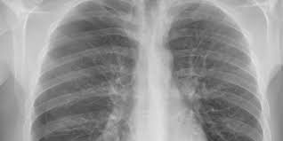 Pneumothorax Detection and Thoracentesis Performance Using Ultrasound Guidance