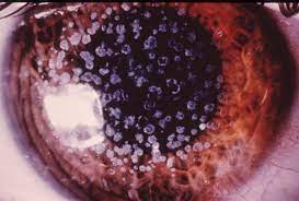 Granular Corneal Dystrophy Type1