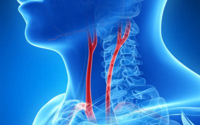 A Case of Giant Extracranial Carotid Artery Aneurysm