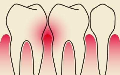 Association between Body Mass Index, Serum Lipids and Periodontal Disease: A Case Control Study