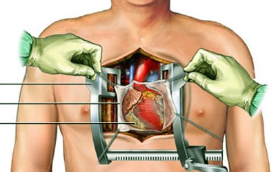 Natriuretic Peptide Levels and Early Respiratory Adverse Outcome in Cardiac Surgery: A Short Review of the Literature