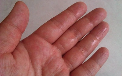 Sympathetic Ablation for Primary
Palmar Hyperhidrosis: Could
Controversies be solved?