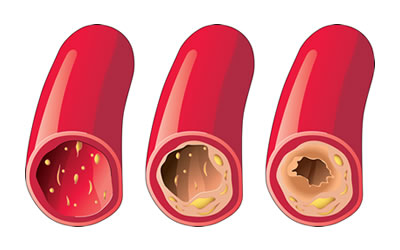 Diagnosis and Treatment of
Atherosclerosis: A Review Article