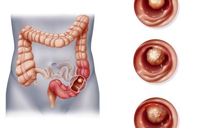 Implantable Port-a-Cath System
Insertion in Patients with
Metastatic Colon Cancer
Receiving Bevacizumab-Based
Chemotherapy