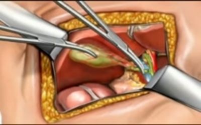 Evaluation of Intraperitoneal and
Port Site Infiltration of
Bupivacaine in Combination with
Fentanyl for Management of
Postoperative Pain following
Laparoscopic Cholecystectomy: A
Double Blind Randomized Study