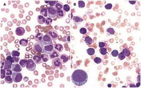 An Update - Chronic Myeloid
Leukemia: An Interaction Between
in Cells, Genes and Molecules