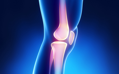 Total Knee Replacement in the
Presence of Proximal Tibial Non-
Union: A Report of Two Cases