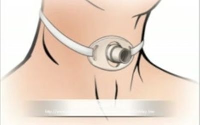 Laryngotracheoplasty for
Laryngotracheal Stenosis Post
Intubation and Post Tracheostomy:
A Case of Stenting with Airway
Exchange Catheter