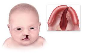 Familial Y Micro deletion with
Cleft Lip